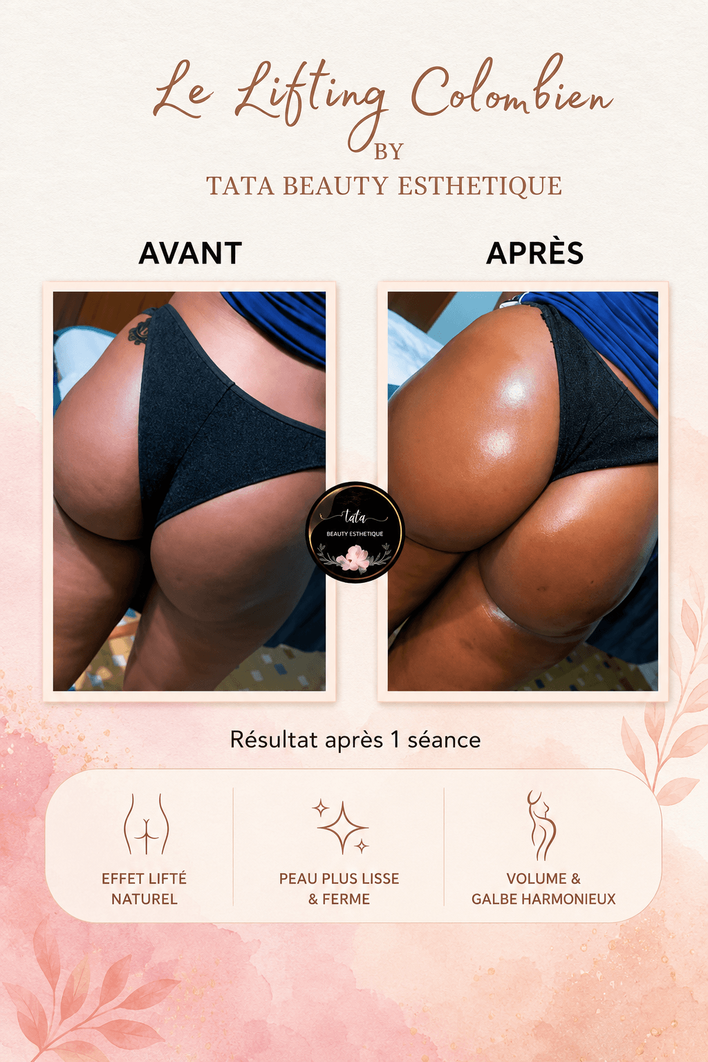 Lifting Colombien — effet lifté, peau ferme et galbe harmonieux