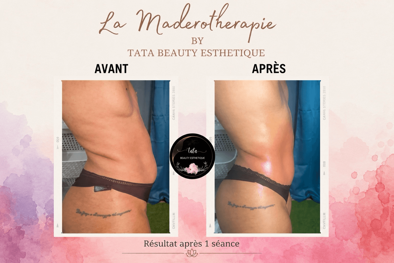 Madérothérapie — résultat après 1 séance (vue de profil)