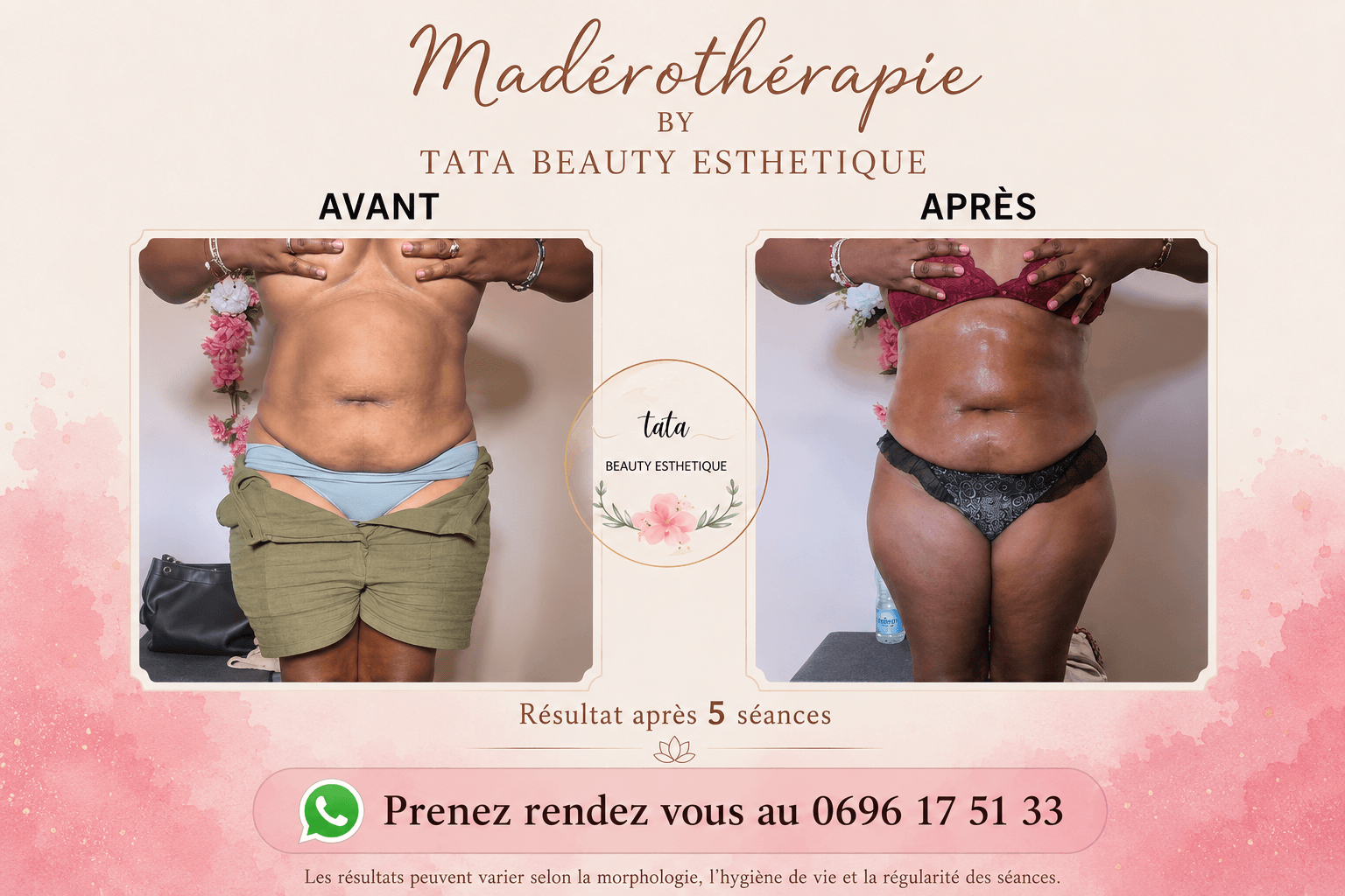 Madérothérapie — résultat avant / après 5 séances (vue de face)